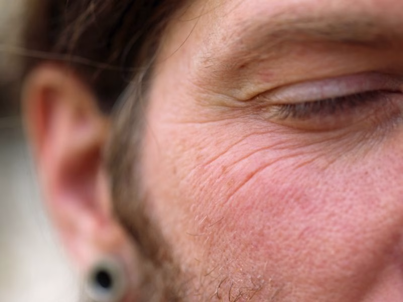 Hombre con piel marcada por arrugas que podrían ser corregidas con Sculptra