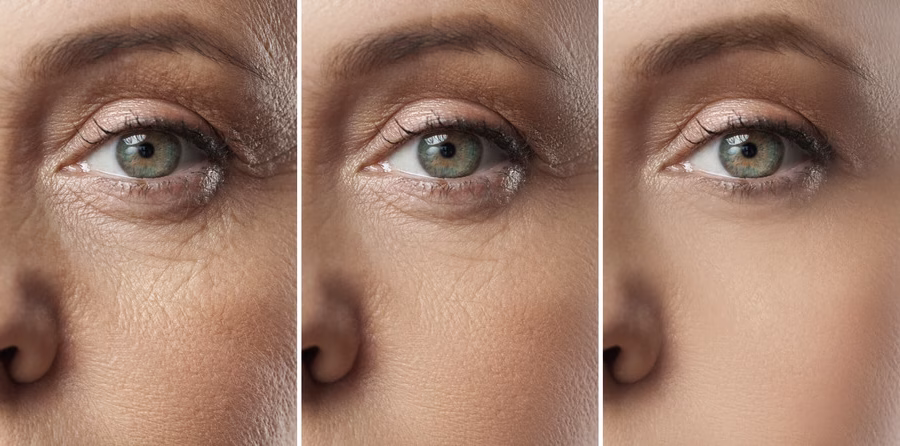 Etapas de mejoramiento de la piel con HArmonyCa