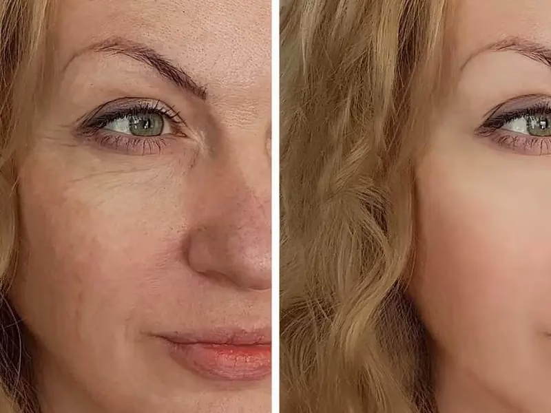 Antes y después en el rostro de una mujer luego de usar Mascarilla Casmara